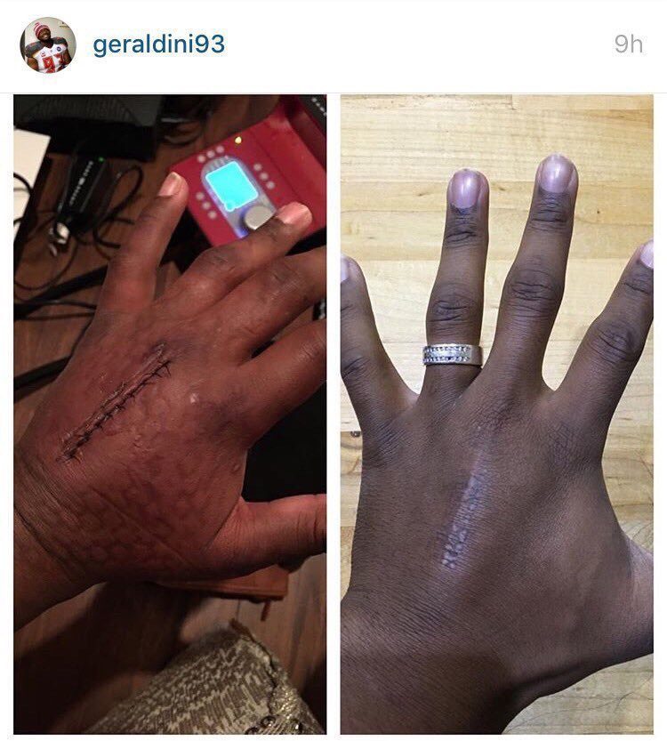 Gerald McCoy posted this gruesome photo of his hand